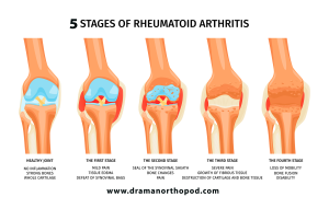 5 Stages of the Knee Arthritis 