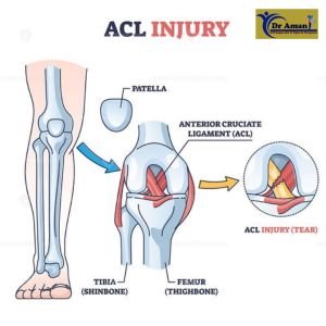 ACL Tore 