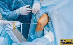 Knee Arthroscopy