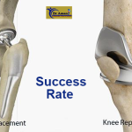 Knee Replacement