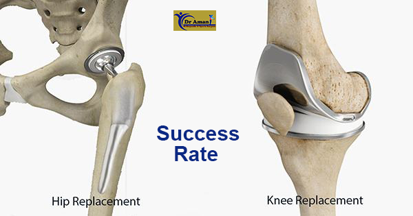 Knee Replacement